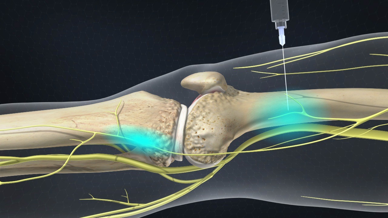 nerve block treatment movewellmd